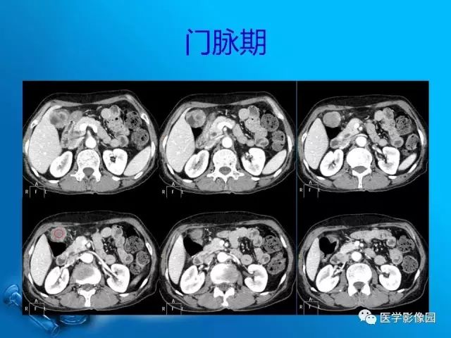 【病例】胆囊癌1例CT影像表现 【病例】胆囊癌1例CT影像表现