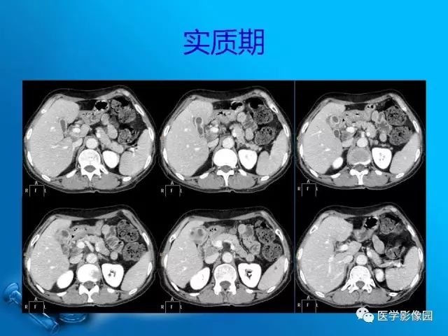【病例】胆囊癌1例CT影像表现 【病例】胆囊癌1例CT影像表现