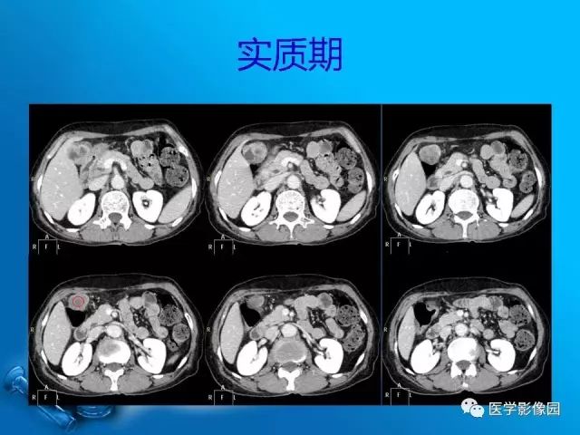 【病例】胆囊癌1例CT影像表现 【病例】胆囊癌1例CT影像表现