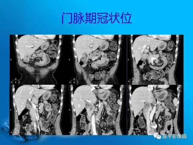 【病例】胆囊癌1例CT影像表现 【病例】胆囊癌1例CT影像表现