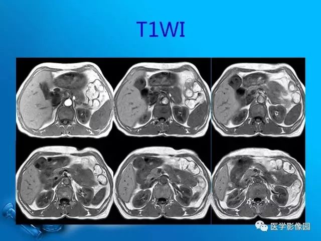 【病例】胆囊癌1例CT影像表现 【病例】胆囊癌1例CT影像表现