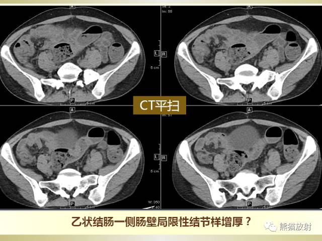 【病例】乙状结肠子宫内膜异位症1例CT诊断思路分析 【病例】乙状结肠子宫内膜异位症1例CT诊断思路分析