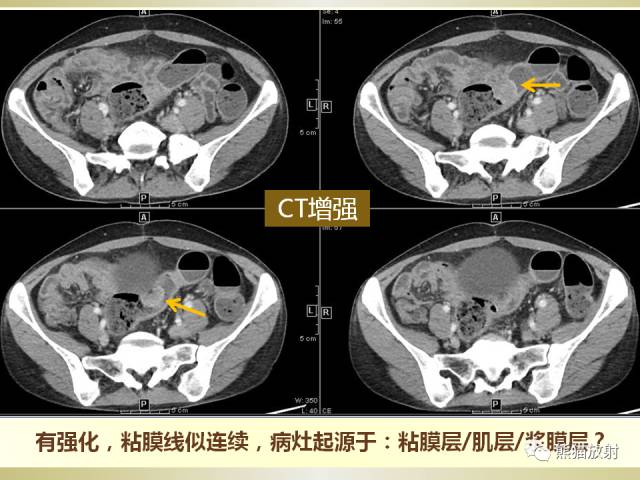 【病例】乙状结肠子宫内膜异位症1例CT诊断思路分析 【病例】乙状结肠子宫内膜异位症1例CT诊断思路分析