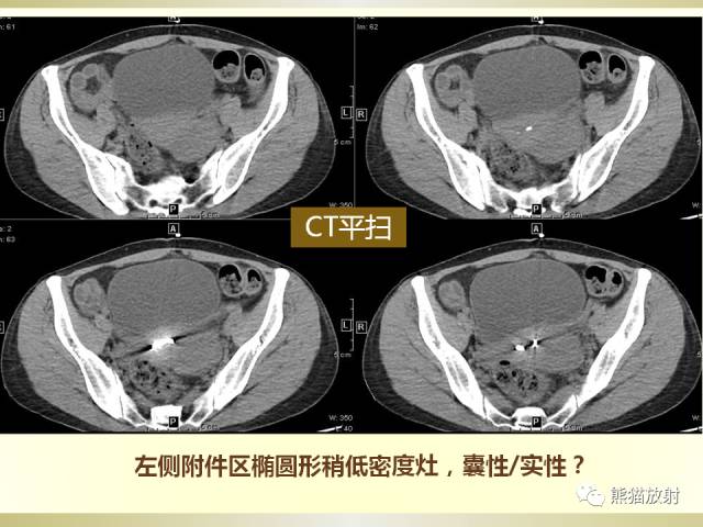 【病例】乙状结肠子宫内膜异位症1例CT诊断思路分析 【病例】乙状结肠子宫内膜异位症1例CT诊断思路分析