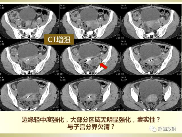 【病例】乙状结肠子宫内膜异位症1例CT诊断思路分析 【病例】乙状结肠子宫内膜异位症1例CT诊断思路分析