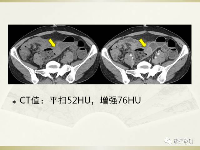 【病例】乙状结肠子宫内膜异位症1例CT诊断思路分析 【病例】乙状结肠子宫内膜异位症1例CT诊断思路分析