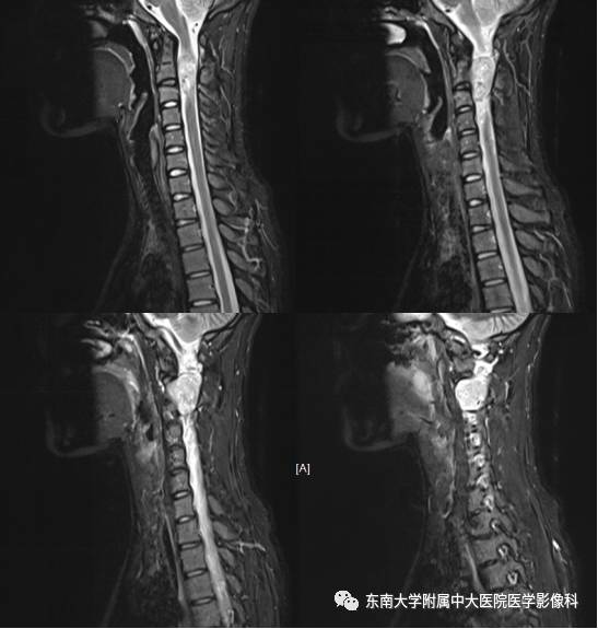【病例】颈椎椎管内神经鞘瘤1例MR