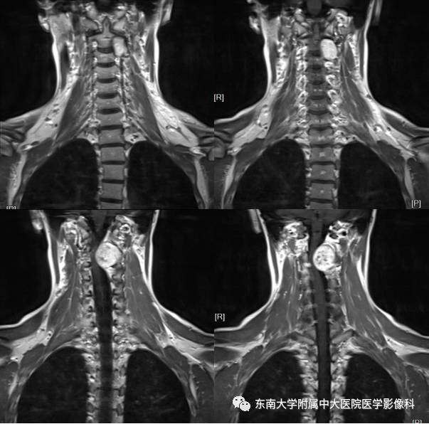 【病例】颈椎椎管内神经鞘瘤1例MR