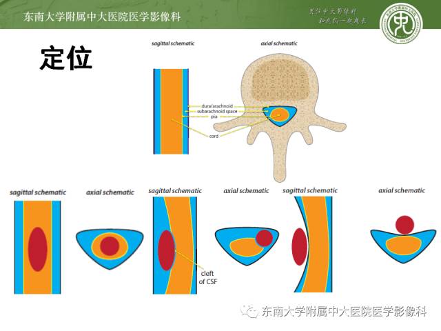 【病例】颈椎椎管内神经鞘瘤1例MR