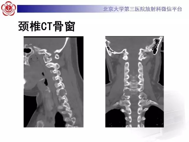 【病例】颈椎腱鞘巨细胞瘤1例CT及MR