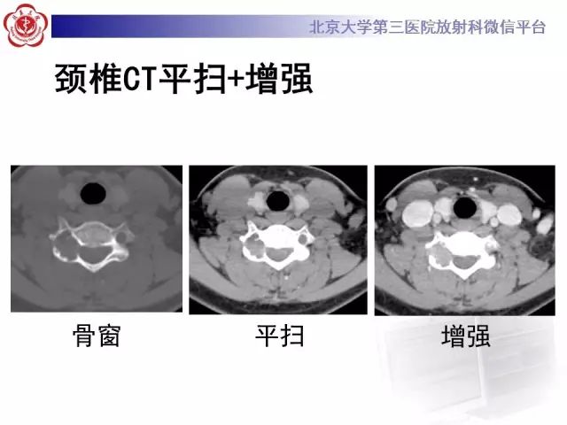 【病例】颈椎腱鞘巨细胞瘤1例CT及MR