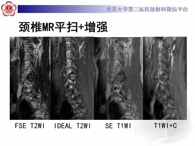 【病例】颈椎腱鞘巨细胞瘤1例CT及MR