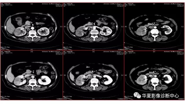 【病例】肾透明细胞癌1例CT影像表现