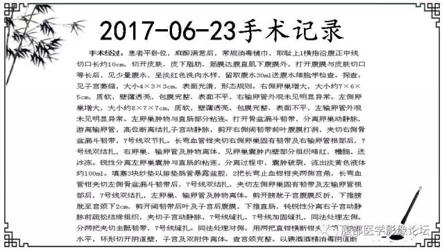 【病例】卵巢高级别浆液性癌1例CT及MR影像表现 【病例】卵巢高级别浆液性癌1例CT及MR影像表现