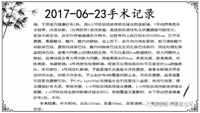 【病例】卵巢高级别浆液性癌1例CT及MR影像表现 【病例】卵巢高级别浆液性癌1例CT及MR影像表现