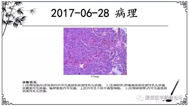 【病例】卵巢高级别浆液性癌1例CT及MR影像表现 【病例】卵巢高级别浆液性癌1例CT及MR影像表现