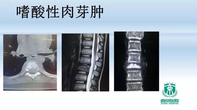 【PPT】常见椎体单发溶骨性病变