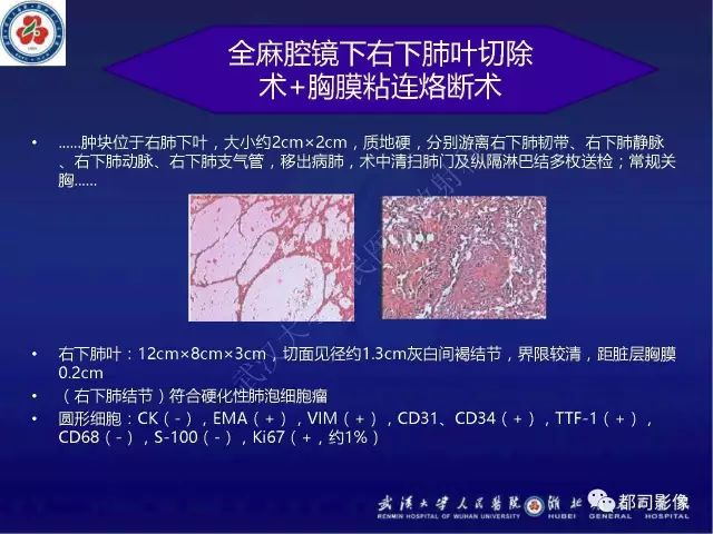 【病例】硬化性肺泡细胞瘤1例CT影像诊断