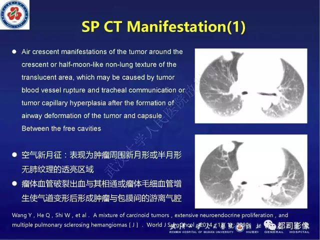 【病例】硬化性肺泡细胞瘤1例CT影像诊断