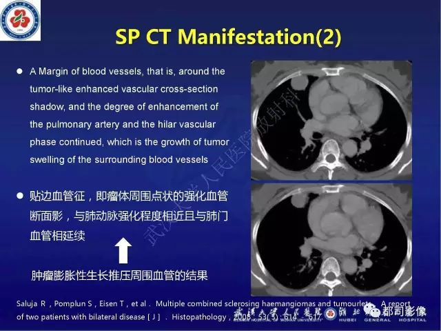 【病例】硬化性肺泡细胞瘤1例CT影像诊断