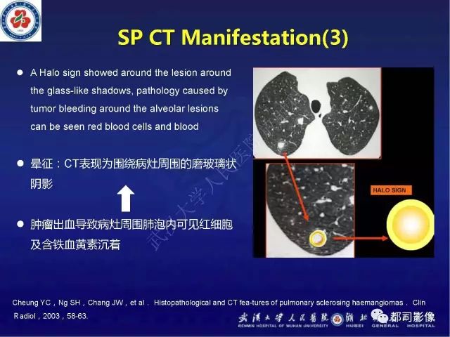 【病例】硬化性肺泡细胞瘤1例CT影像诊断