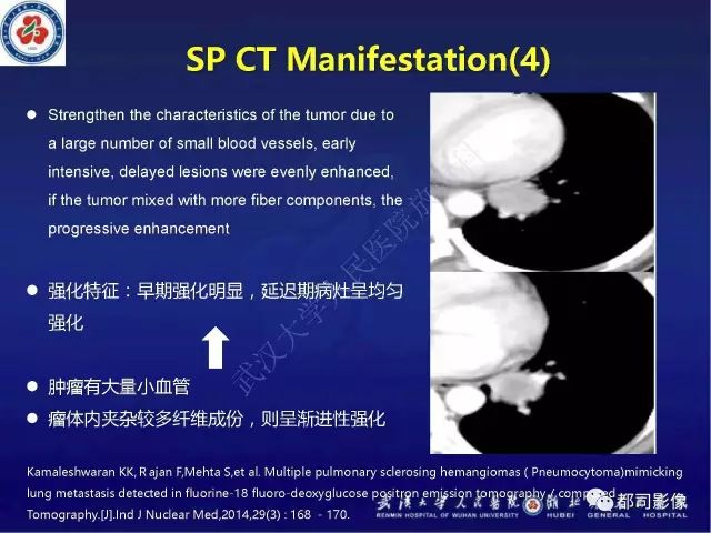 【病例】硬化性肺泡细胞瘤1例CT影像诊断