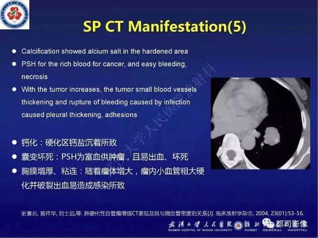 【病例】硬化性肺泡细胞瘤1例CT影像诊断