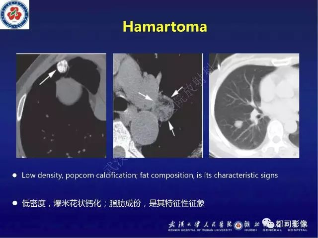 【病例】硬化性肺泡细胞瘤1例CT影像诊断