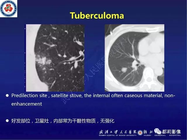 【病例】硬化性肺泡细胞瘤1例CT影像诊断