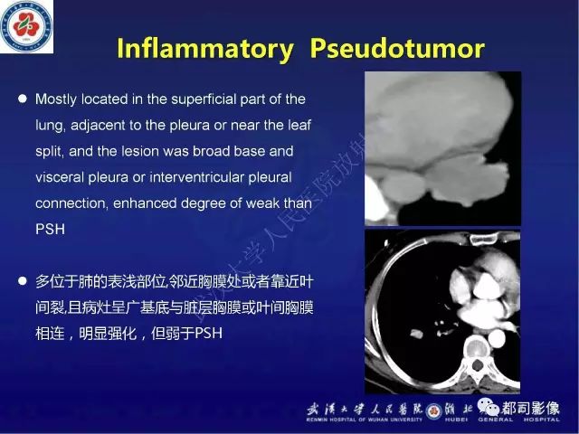【病例】硬化性肺泡细胞瘤1例CT影像诊断