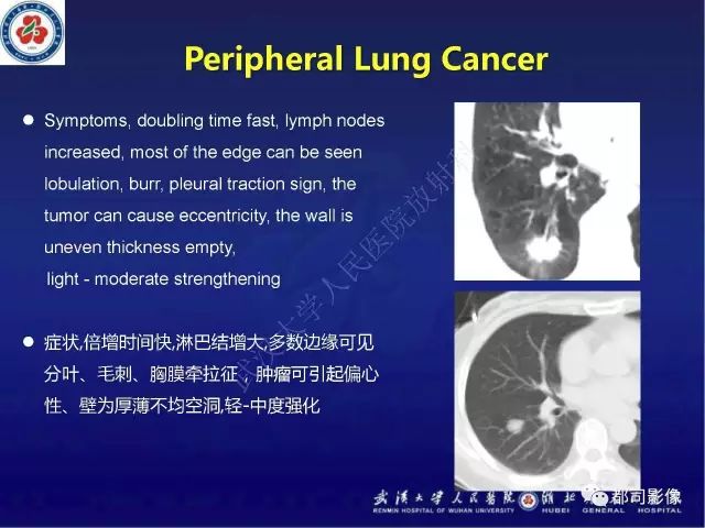 【病例】硬化性肺泡细胞瘤1例CT影像诊断