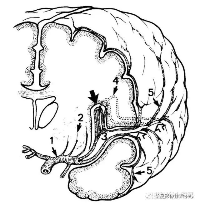 大脑中动脉分段详解(简图+DSA+实体解剖) 大脑中动脉分段详解(简图+DSA+实体解剖)