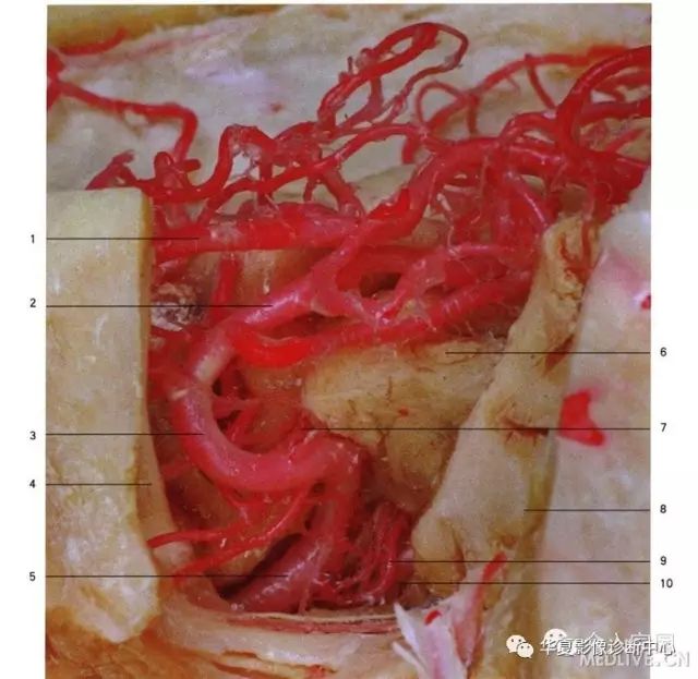 大脑中动脉分段详解(简图+DSA+实体解剖) 大脑中动脉分段详解(简图+DSA+实体解剖)