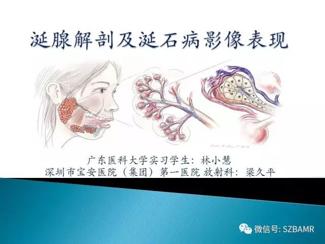 【PPT】涎腺解剖及涎石病影像表现