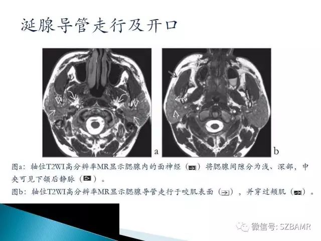 【PPT】涎腺解剖及涎石病影像表现