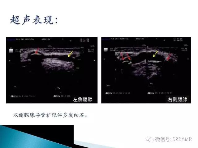 【PPT】涎腺解剖及涎石病影像表现