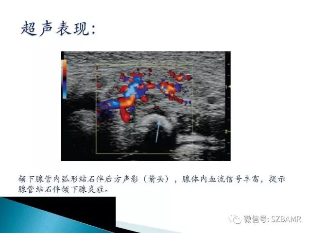 【PPT】涎腺解剖及涎石病影像表现