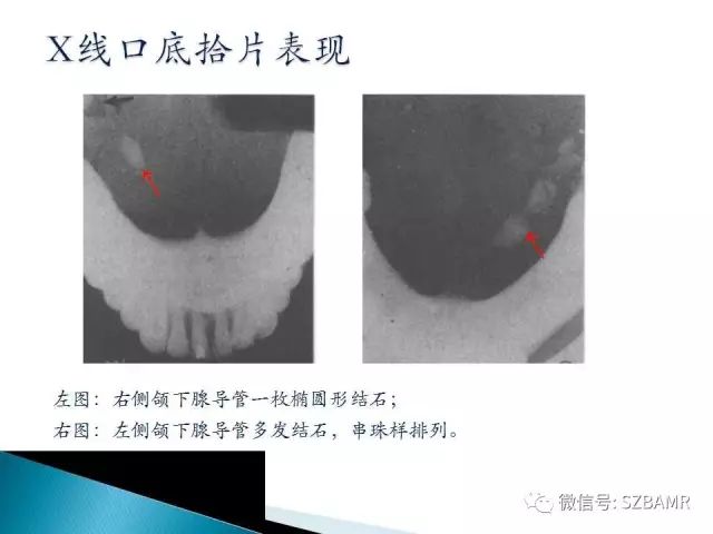 【PPT】涎腺解剖及涎石病影像表现