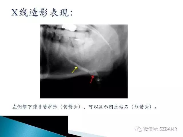 【PPT】涎腺解剖及涎石病影像表现