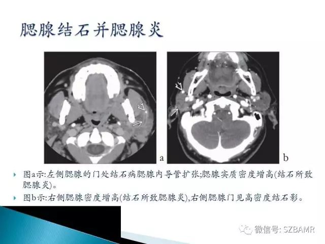 【PPT】涎腺解剖及涎石病影像表现