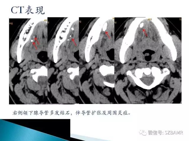 【PPT】涎腺解剖及涎石病影像表现