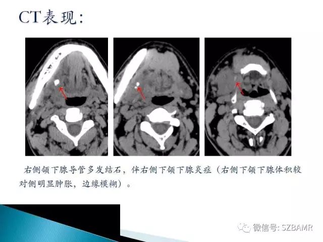 【PPT】涎腺解剖及涎石病影像表现