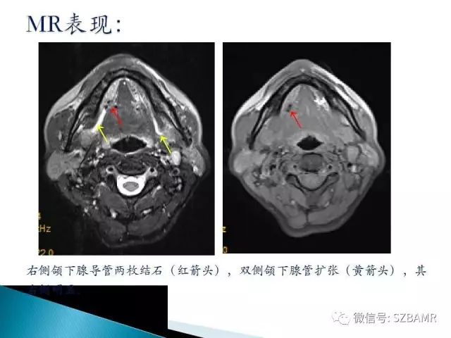 【PPT】涎腺解剖及涎石病影像表现