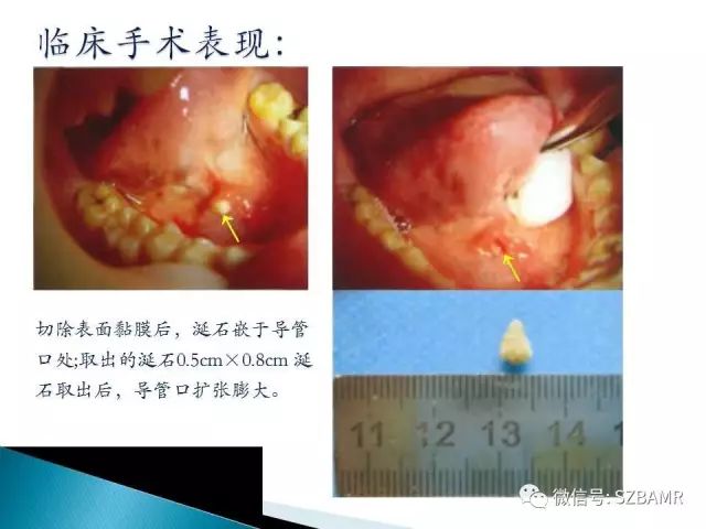 【PPT】涎腺解剖及涎石病影像表现