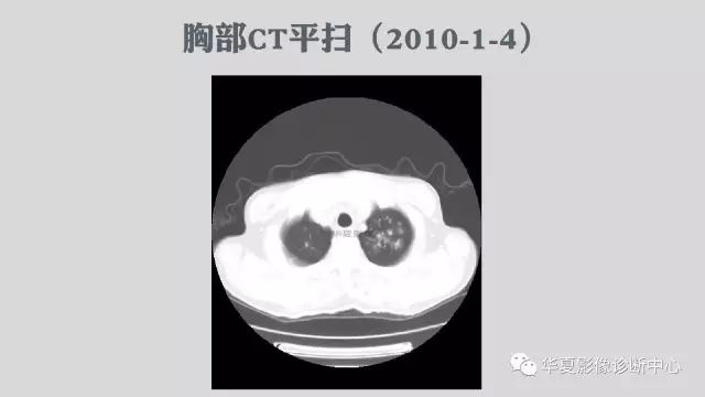 【病例】侵袭性肺曲霉菌病例追踪CT影像表现