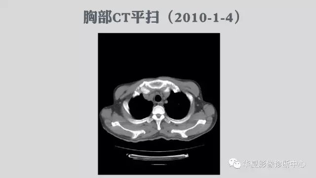【病例】侵袭性肺曲霉菌病例追踪CT影像表现