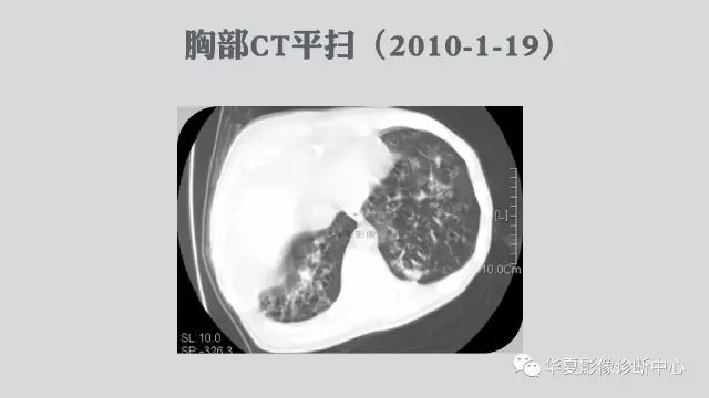 【病例】侵袭性肺曲霉菌病例追踪CT影像表现