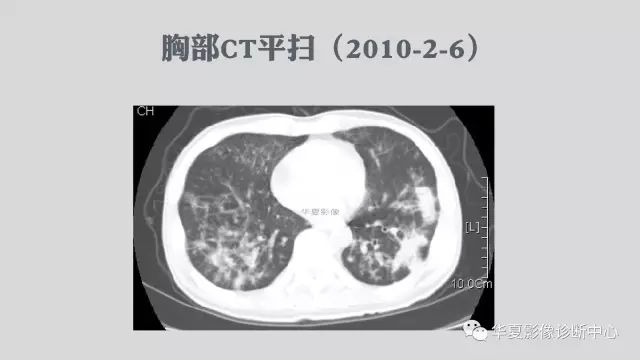 【病例】侵袭性肺曲霉菌病例追踪CT影像表现