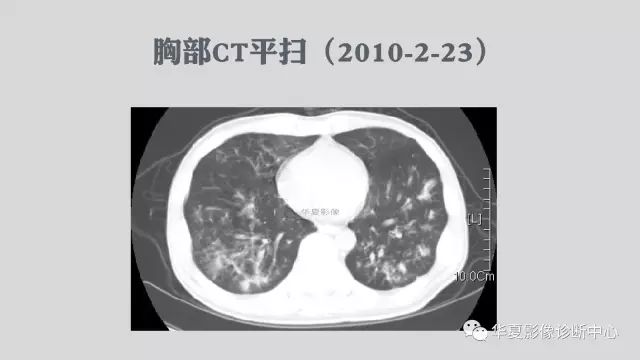 【病例】侵袭性肺曲霉菌病例追踪CT影像表现
