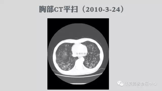 【病例】侵袭性肺曲霉菌病例追踪CT影像表现